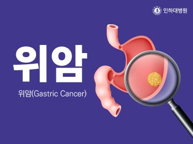 [건강의학정보] 위암