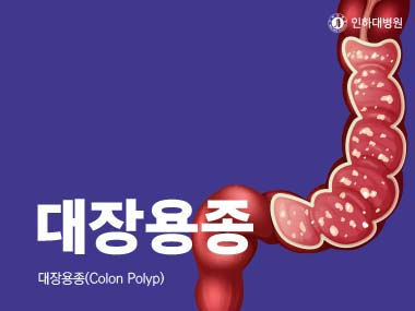 [건강의학정보] 대장용종