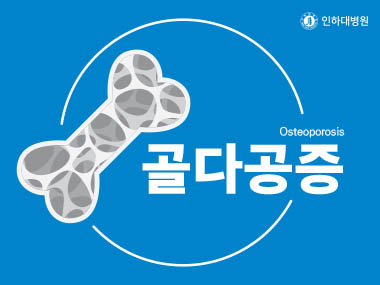 [건강의학정보] 골다공증