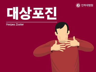 [건강의학정보] 대상포진