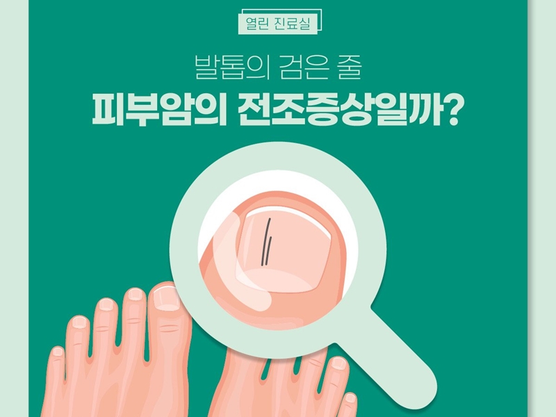 [열린진료실] 발톱의 검은 줄, 피부암의 전조증상일까?