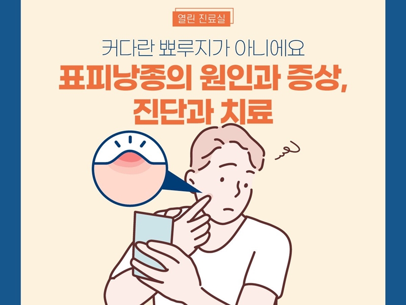 [열린진료실] 커다란 뾰루지가 아니에요 표피낭종의 원인과 증상, 진단과 치료