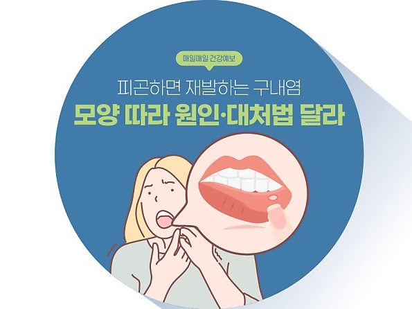 [매일매일 건강예보] 피곤하면 재발하는 구내염, 모양 따라 원인·대처법 달라