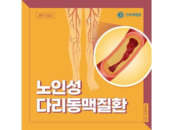 [열린 진료실] 오래 걷지 못하고, 잠시 쉬어야만 호전된다면? 노인성 다리동맥질환 의심 