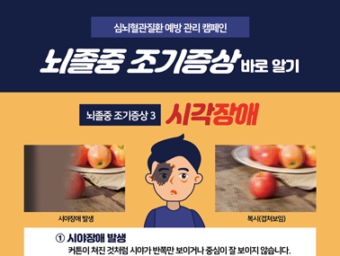 [인포그래픽] 뇌졸중 조기증상 3 - 시각장애