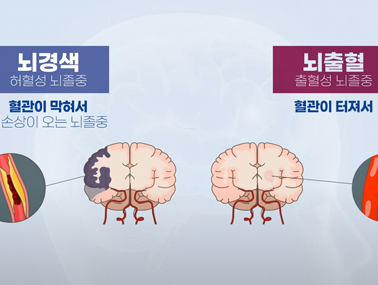 허혈성 뇌졸중(뇌경색)이란 - 뇌경색 바로 알기