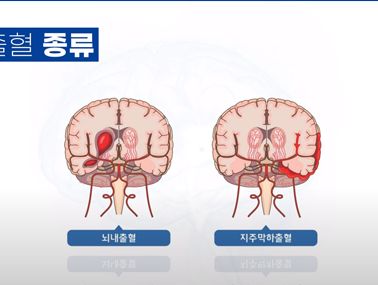 출혈성 뇌졸중(뇌출혈)이란 - 뇌출혈 바로 알기