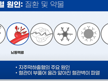 뇌출혈 위험요인 - 뇌출혈 바로 알기