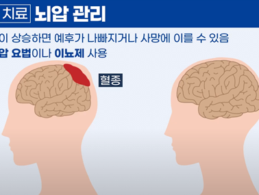 뇌출혈 치료 - 뇌출혈 바로 알기