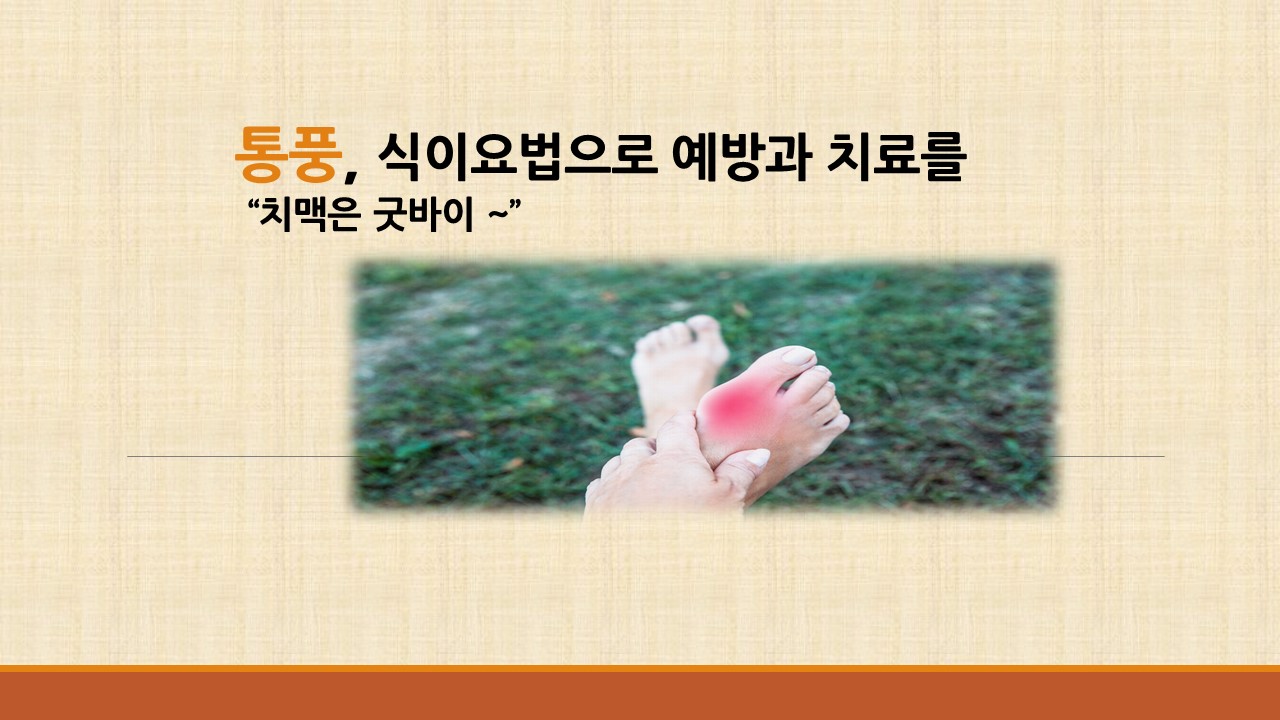 [의학칼럼] 통풍, 식이요법으로 예방과 치료를 "치맥은 굿바이~"