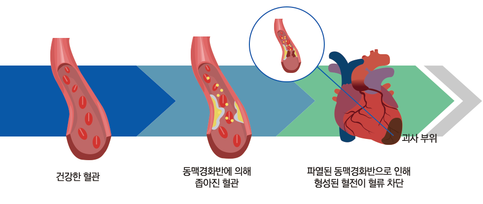 동맥경화의 진행과정: 건강한 혈관 -> 동맥경화반에 의해 좁아진 혈관 -> 파열된 동맥경화반으로 인해 형성된 혈전이 혈류 차단