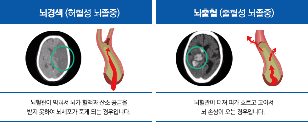 뇌경색 - 허혈성 뇌졸중, 뇌혈관이 막혀서 뇌가 혈액과 산소 공급을 받지 못하여 뇌세포가 죽게 되는 경우입니다. 뇌출혈 - 출혈성 뇌졸중, 뇌혈관이 터져 피가 흐르고 고여서 뇌 손상이 오는 경우입니다.