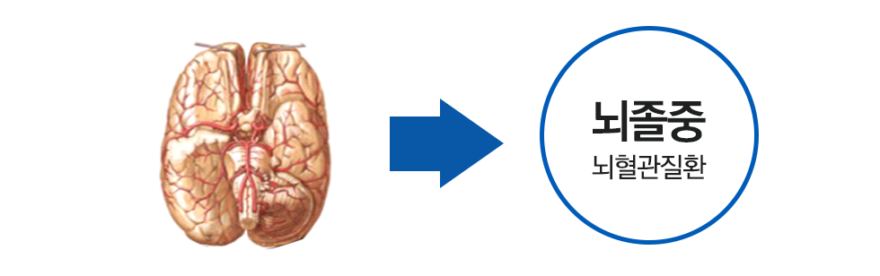 뇌졸중 뇌혈관질환