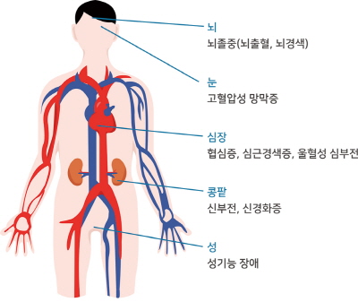 눈:고혈압성 망막증. 뇌:뇌졸중(뇌출혈,뇌경색). 콩팥:신부전,신경화증. 심장:협심증,심근경색증,울혈성 심부전. 성:성기능 장애