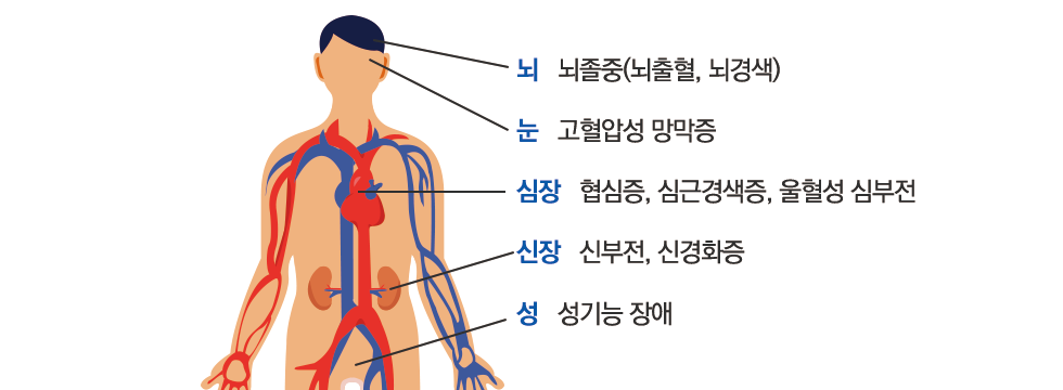 눈:고혈압성 망막증. 뇌:뇌졸중(뇌출혈,뇌경색). 콩팥:신부전,신경화증. 심장:협심증,심근경색증,울혈성 심부전. 성:성기능 장애