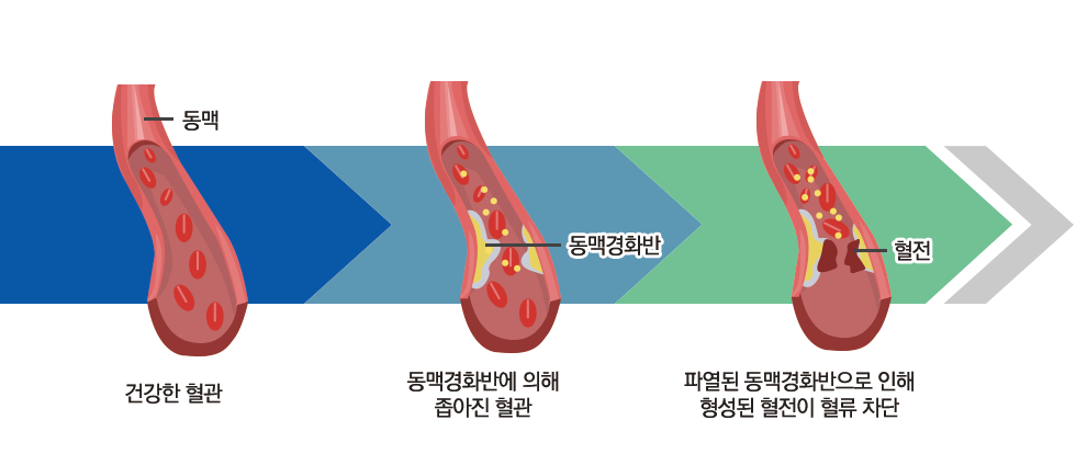 동맥 동맥경화반 혈전